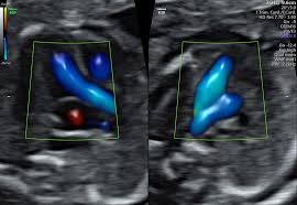Import SONOVCAD Heart for Color Doppler Ultrasound Scanner